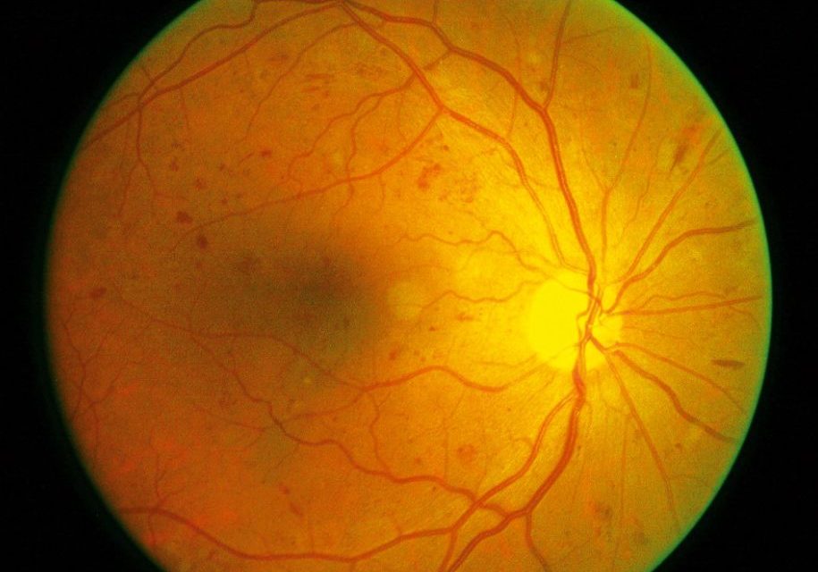 Diagnosticarea retinopatiei diabetice cu ajutorul algoritmilor AI